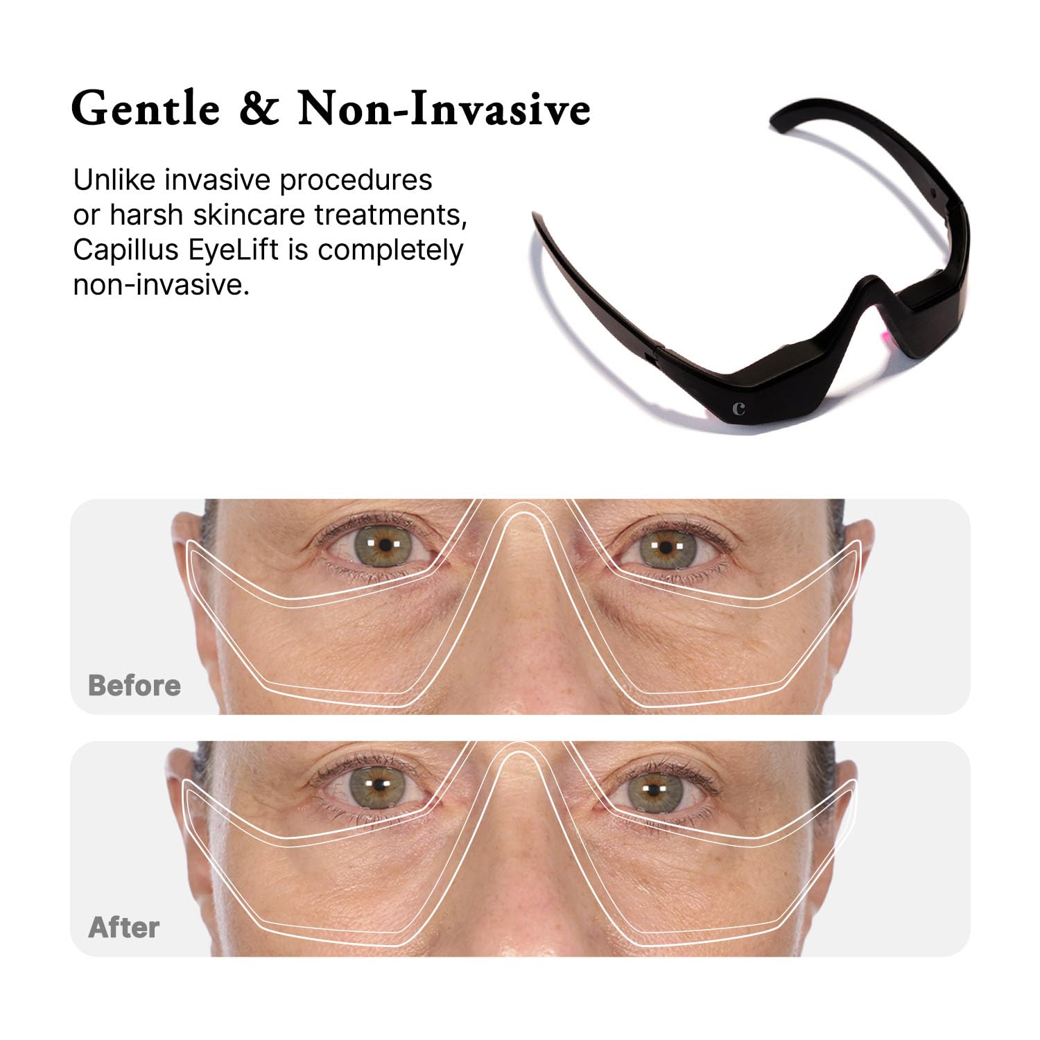 Capillus Eyelift Red Light Therapy for Eyes - Under Eye Red Light Therapy Glasses 685nm - Red Light Therapy for Eyes Bags, Wrinkles, Fine Lines, Crow's Feet and Dark Circles